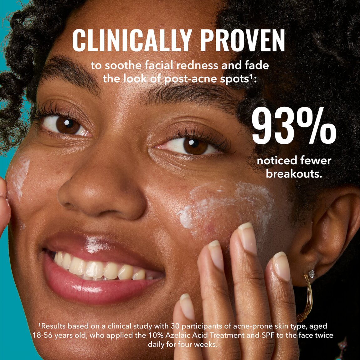 10-azelaic-acid-treatment-m8 zb_p.jpg