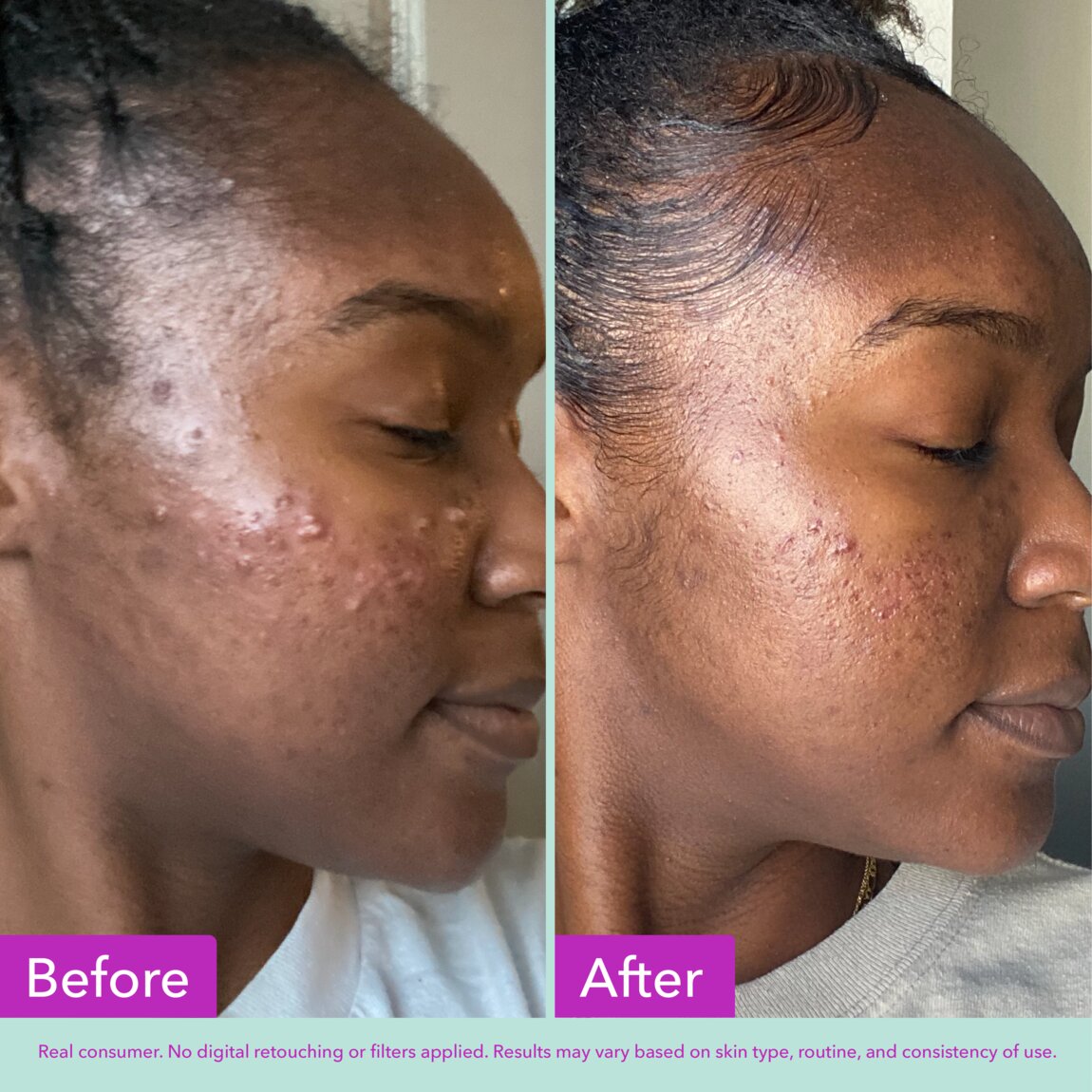 acne-foaming-cleanser-f2 zb_p.jpg